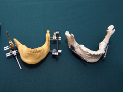 External distractor system (left) and internal distractor system (right).