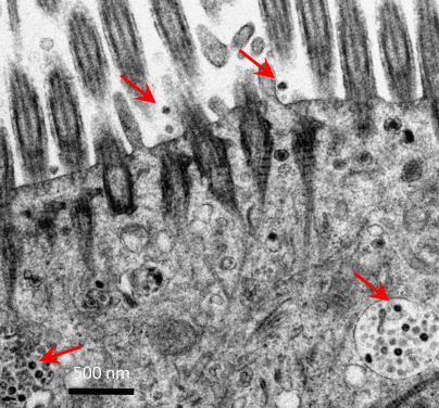 Electron micrograph of the human bronchus tissues after infection with SARS-CoV-2. Red arrows showing viral particles.



 