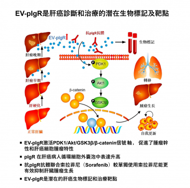 港大醫學院發現肝癌患者體內細胞外囊泡中的關鍵分子可作為肝癌早期診斷生物標記以及腫瘤治療靶點